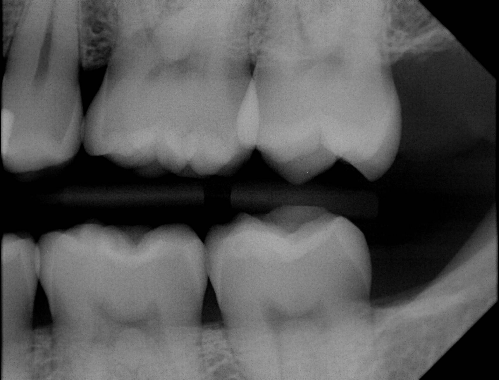 Apex Dental Sensor XRays