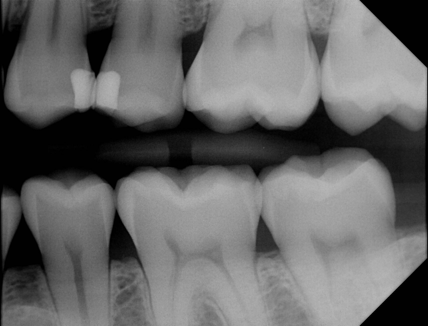 Apex Dental Sensor XRays