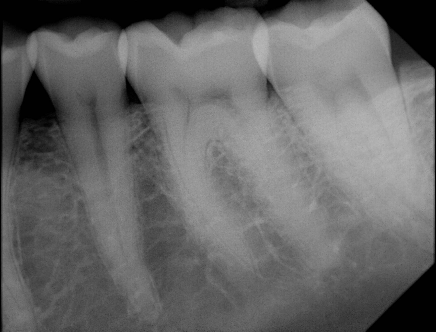 Apex Dental Sensor XRays