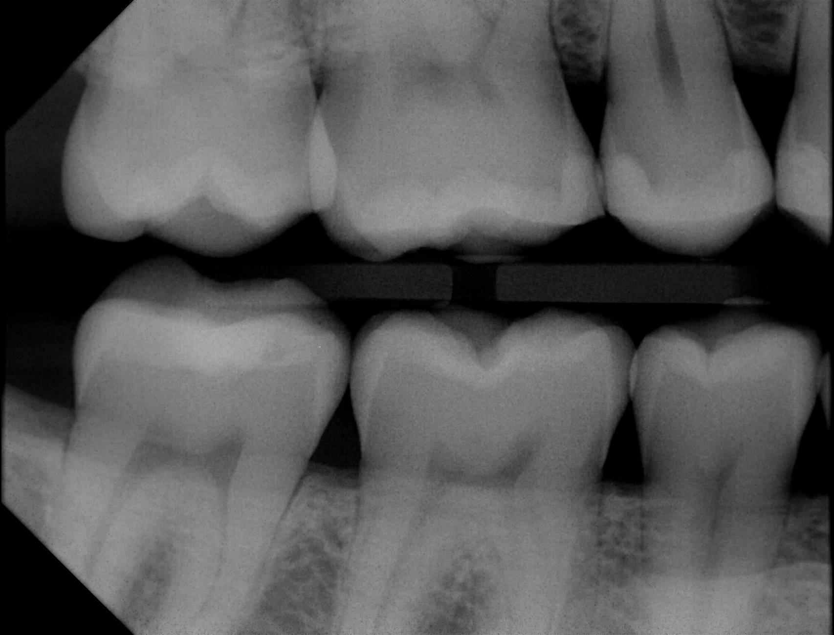 Apex-Dental-Sensor-Sample-X-Ray-8