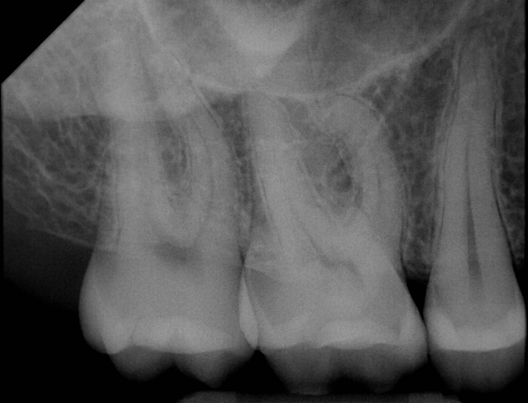 Apex-Dental-Sensor-Sample-X-Ray-1