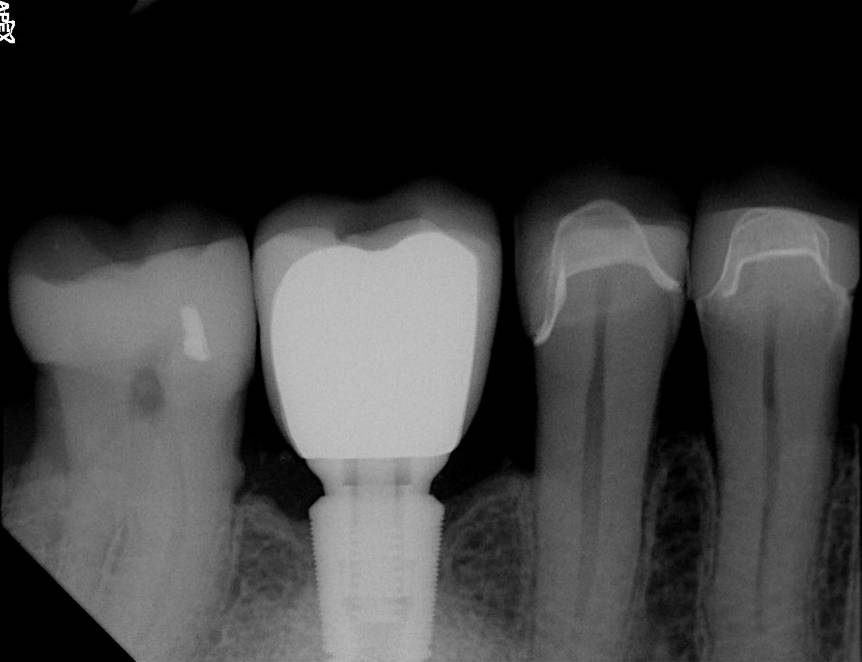 Apex Dental Sensor XRays