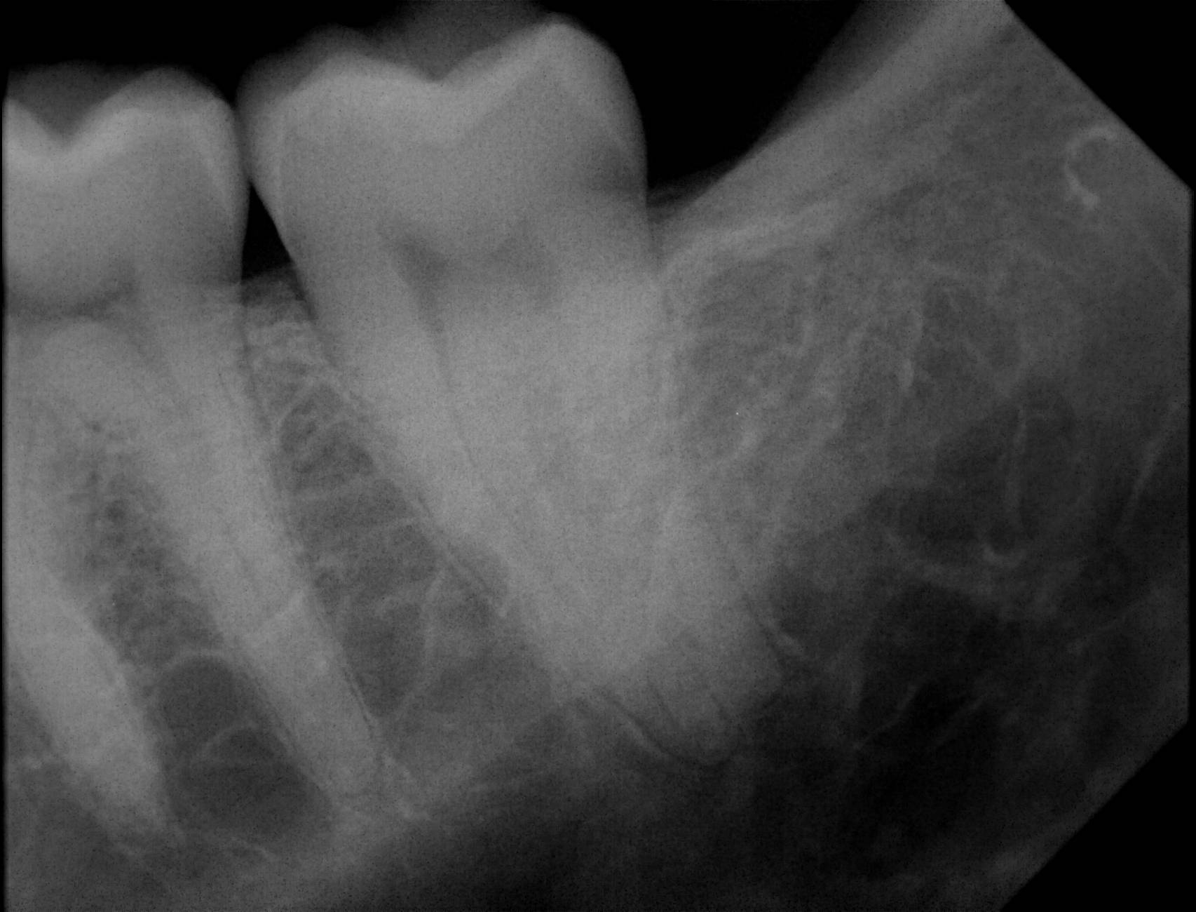 Apex-Dental-Sensor-Sample-X-Ray-18