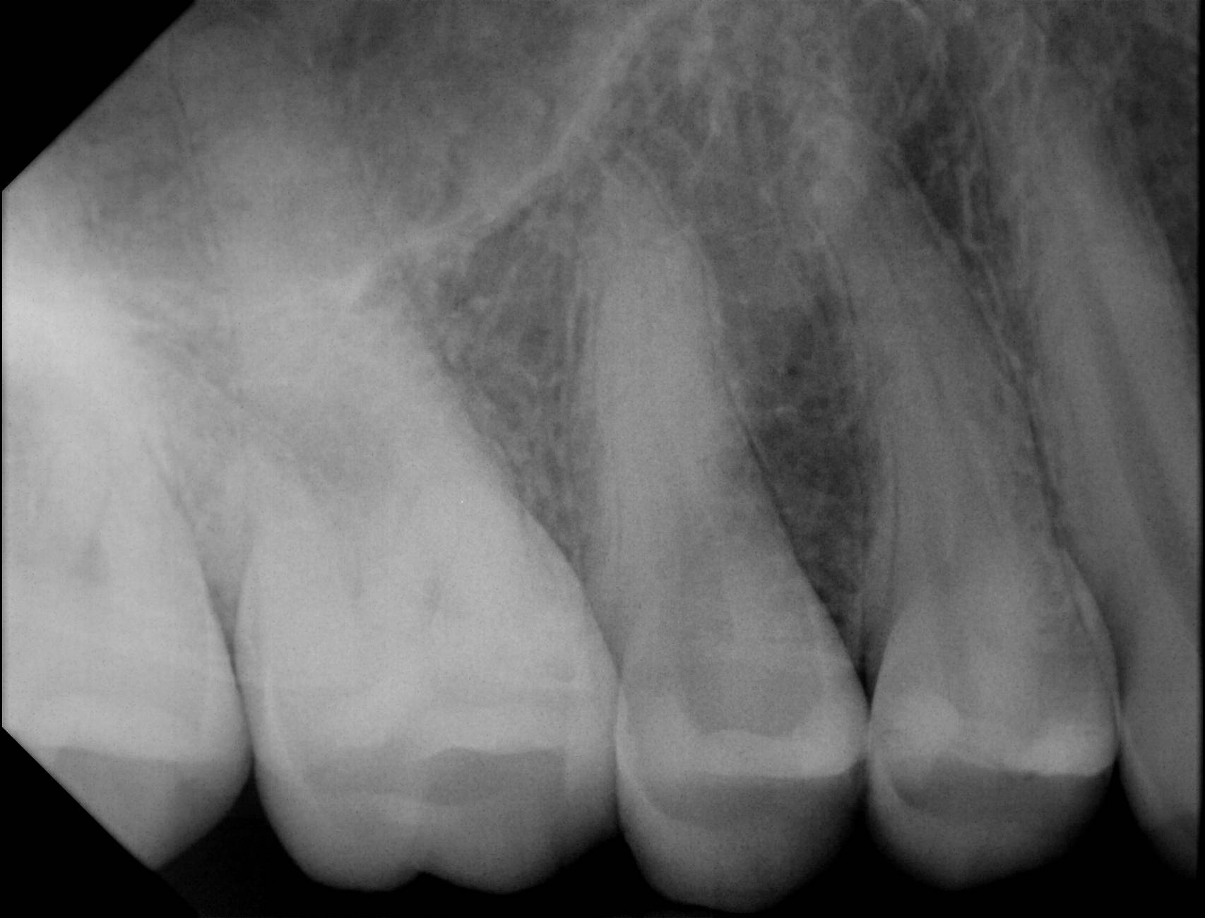 Apex-Dental-Sensor-Sample-X-Ray-2