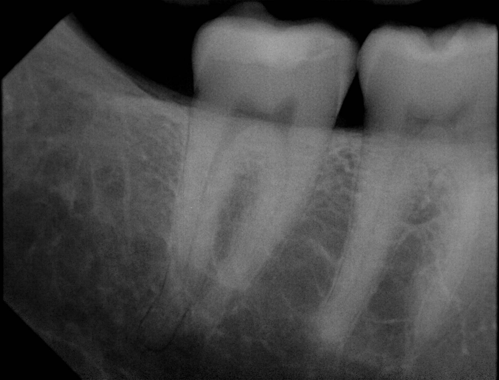 Apex-Dental-Sensor-Sample-X-Ray-12