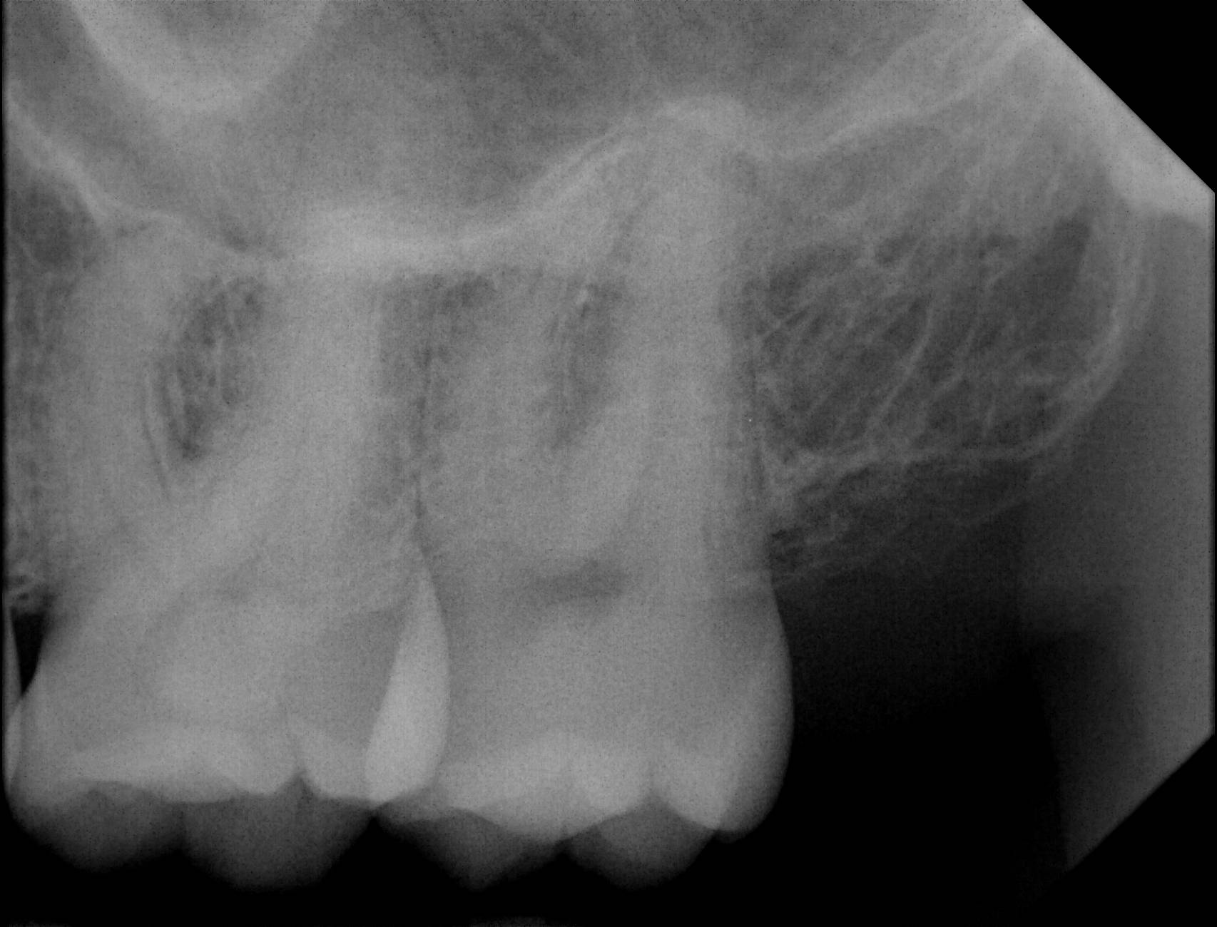 Apex Dental Sensor XRays