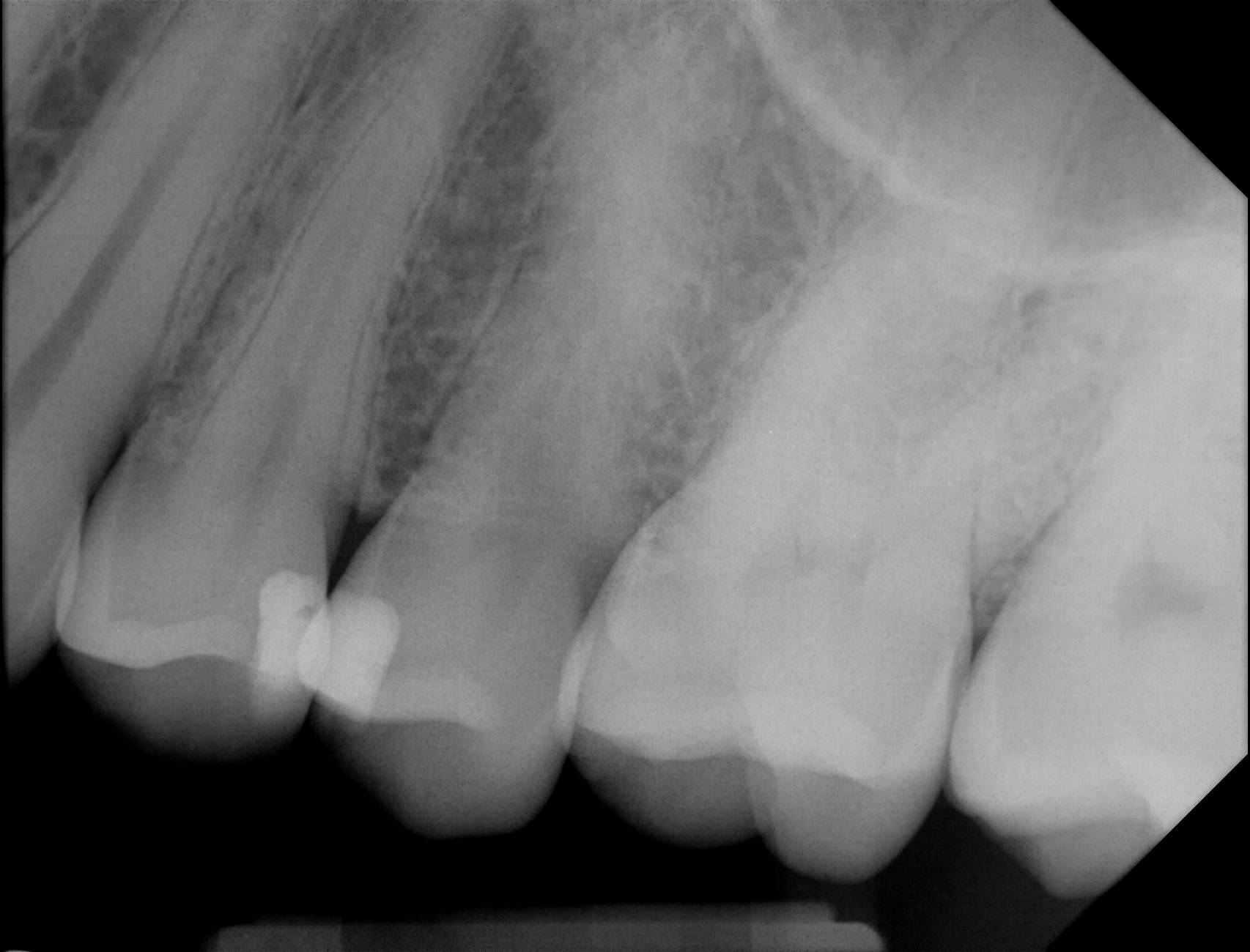 Apex-Dental-Sensor-Sample-X-Ray-6