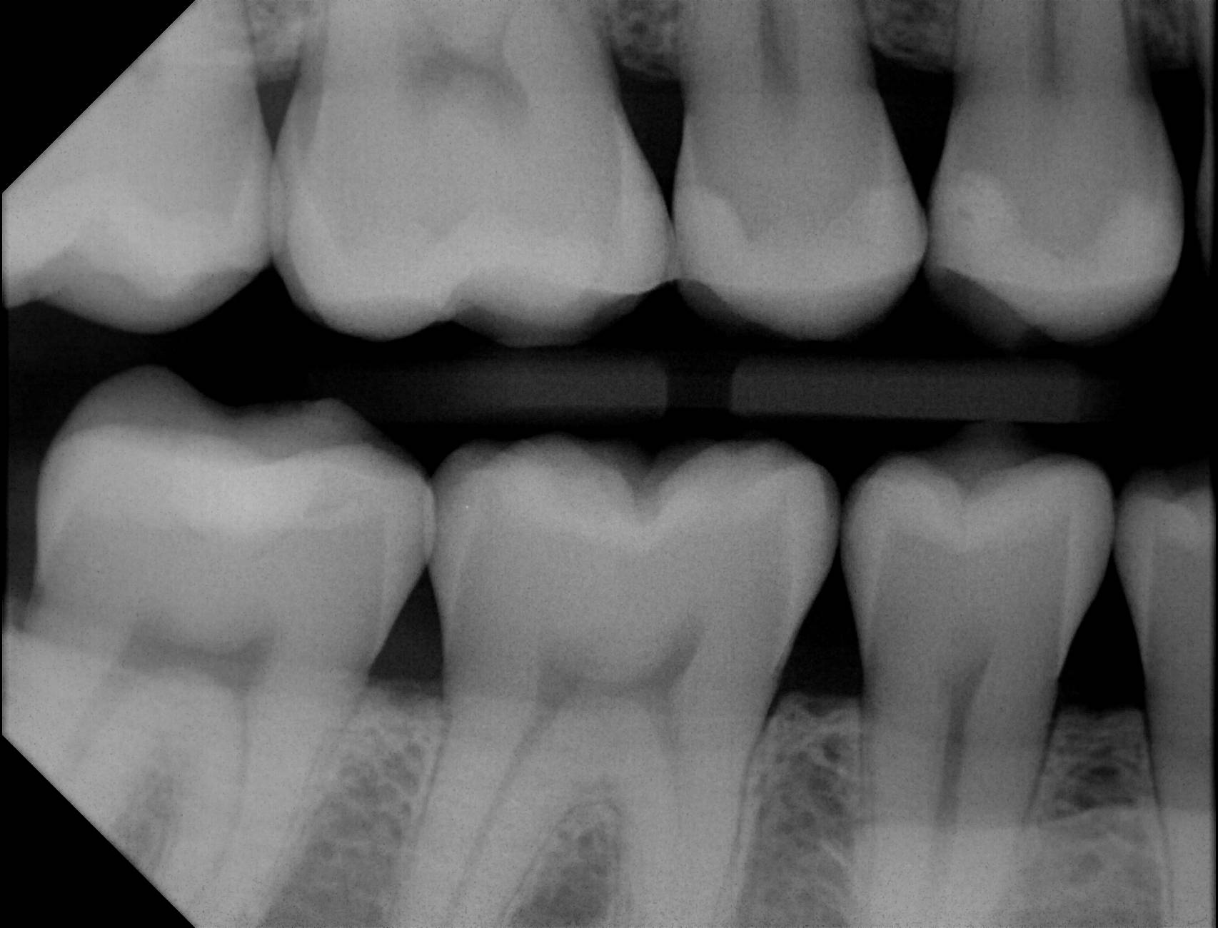 Apex Dental Sensor XRays